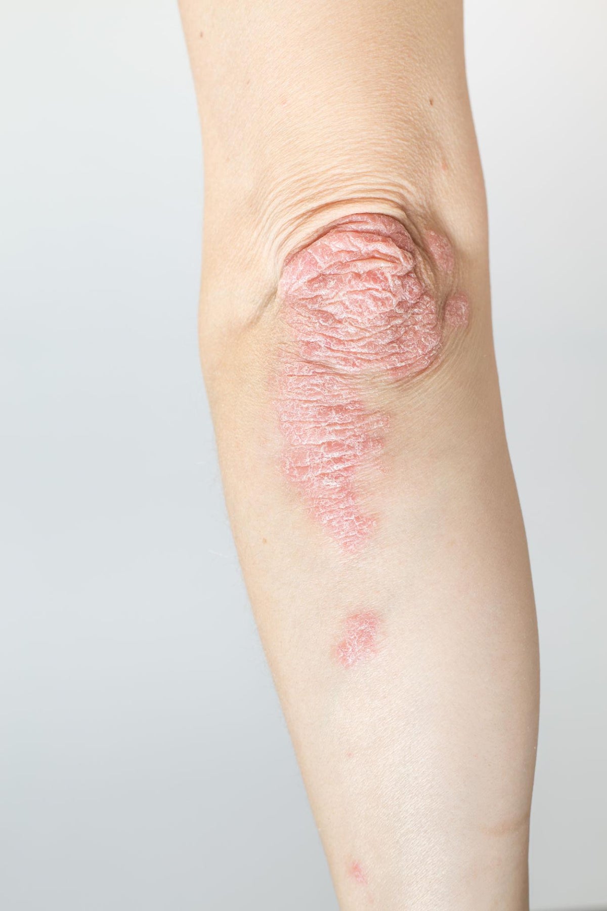 Psoriasis on elbow