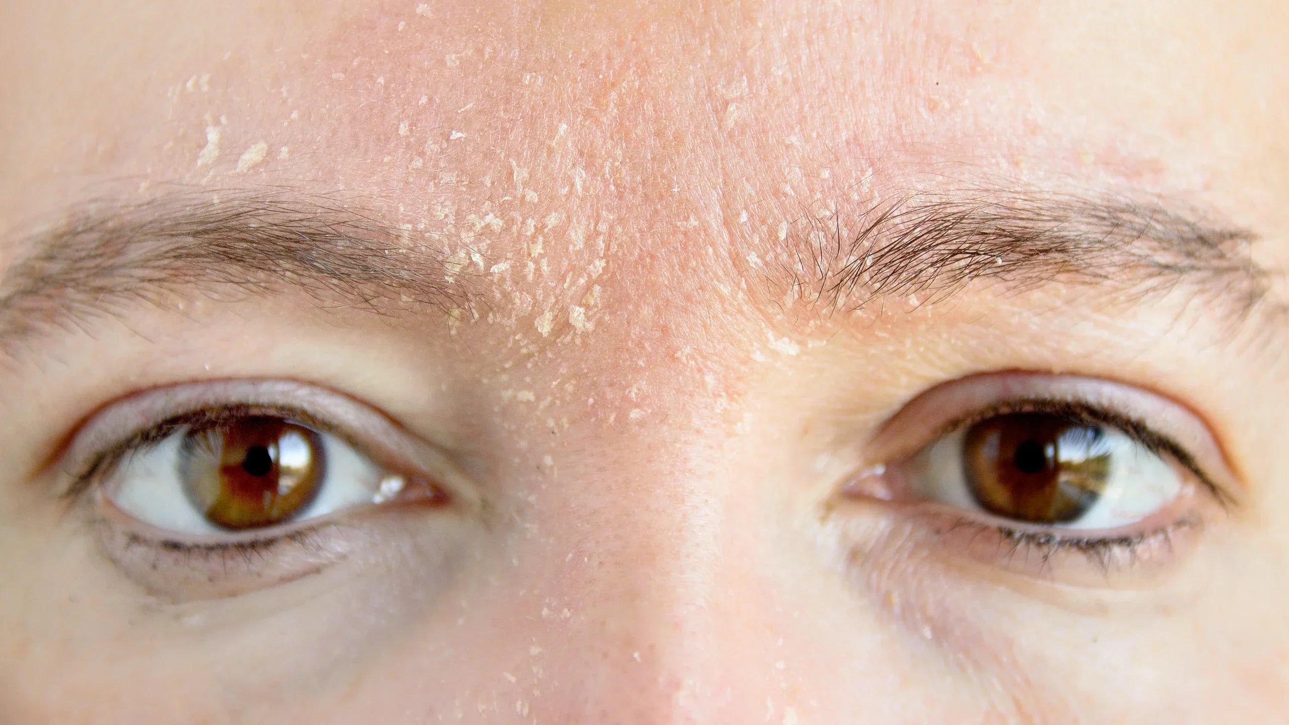 damaged skin barrier redness close up