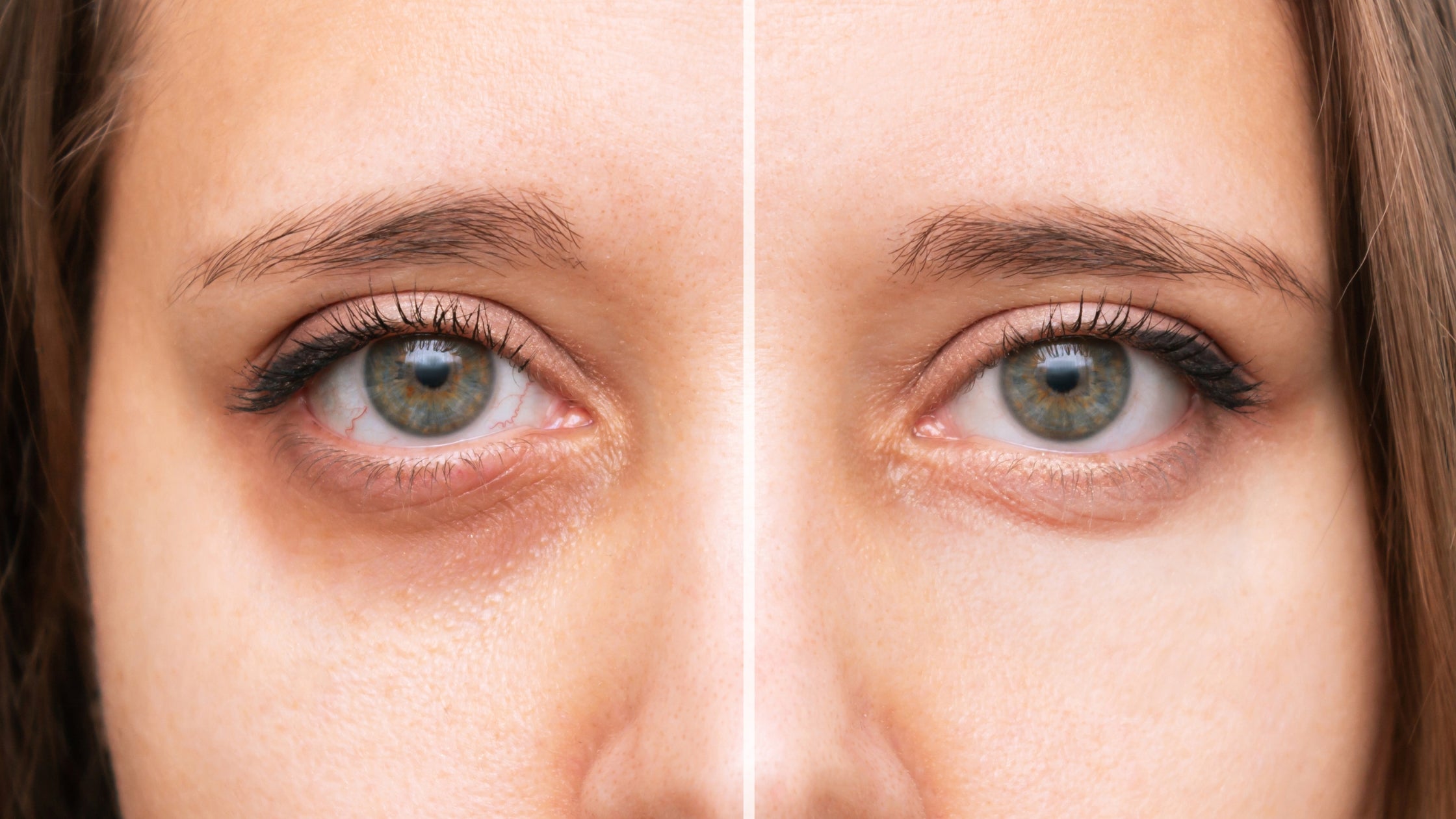 Dark Circles Under Eye Oil