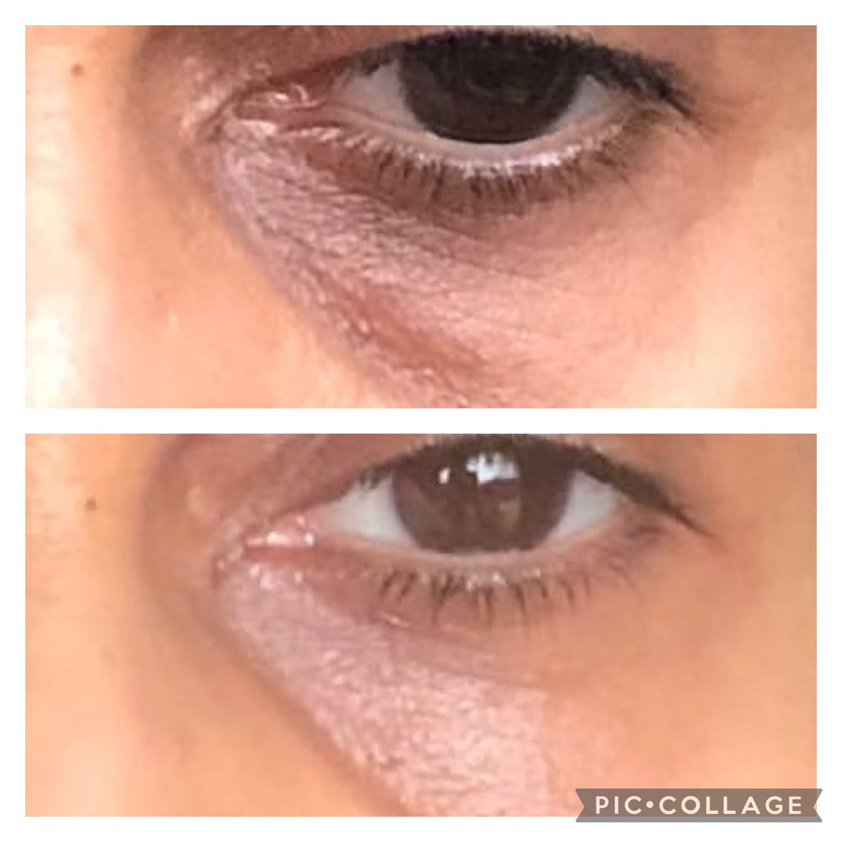 What Causes Pigmentation Under the Eyes? Understanding Brown Dark Circles