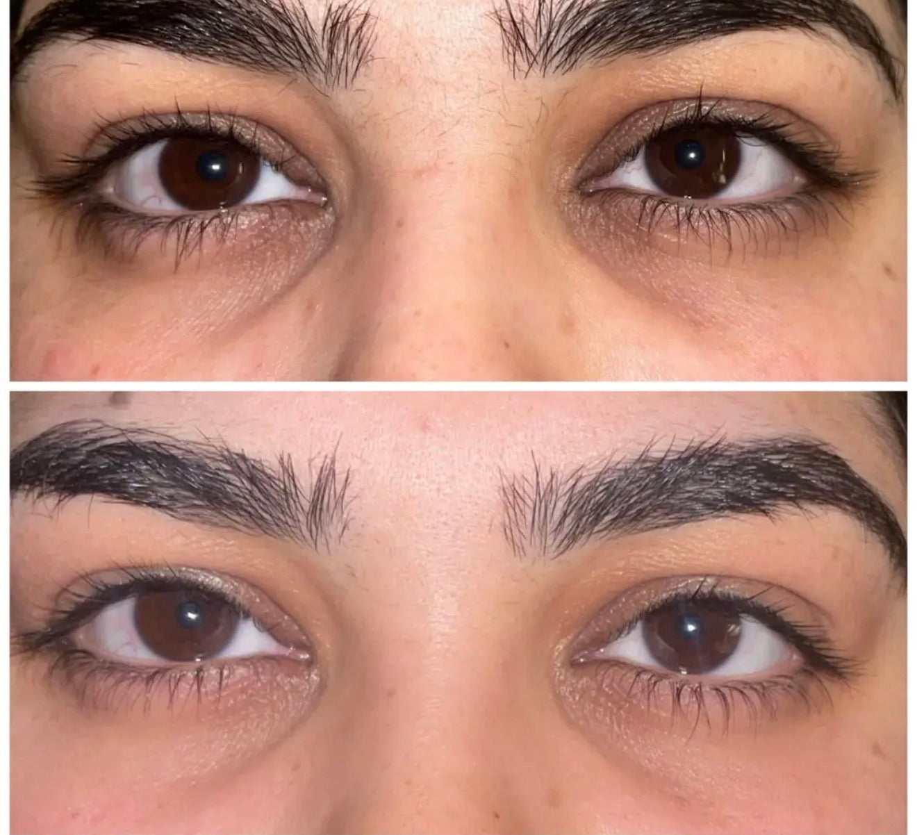 Why Have My Dark Circles Suddenly Got Worse?