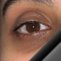 Why Do I Have Dark Circles Under My Eyes?