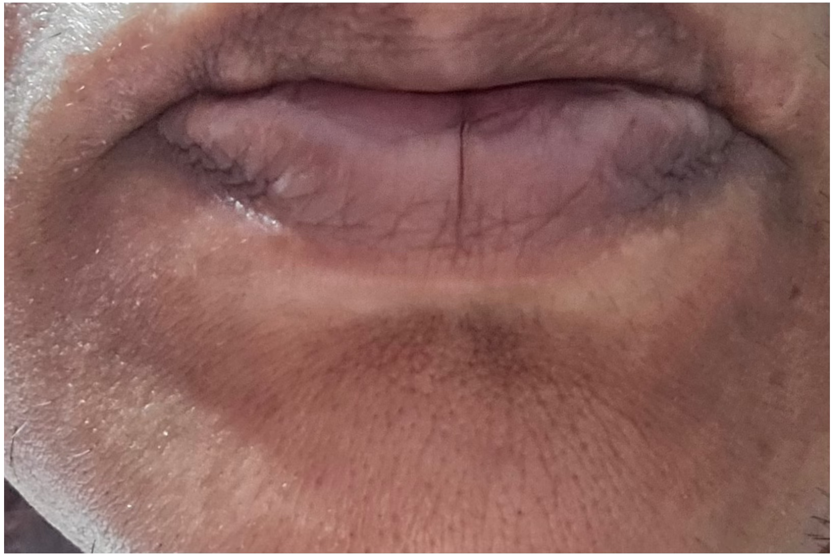Post-inflammatory hyperpigmentation, melasma or sun spots: what's the difference, and why it matters