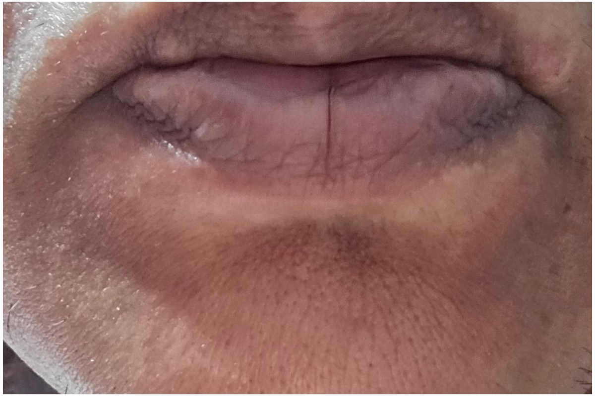 Post-inflammatory hyperpigmentation, melasma or sun spots: what's the difference, and why it matters