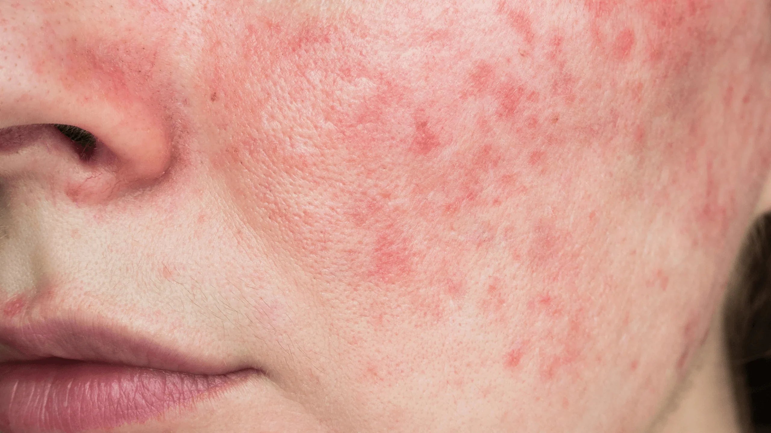 red irritated sensitive skin on cheeks close up