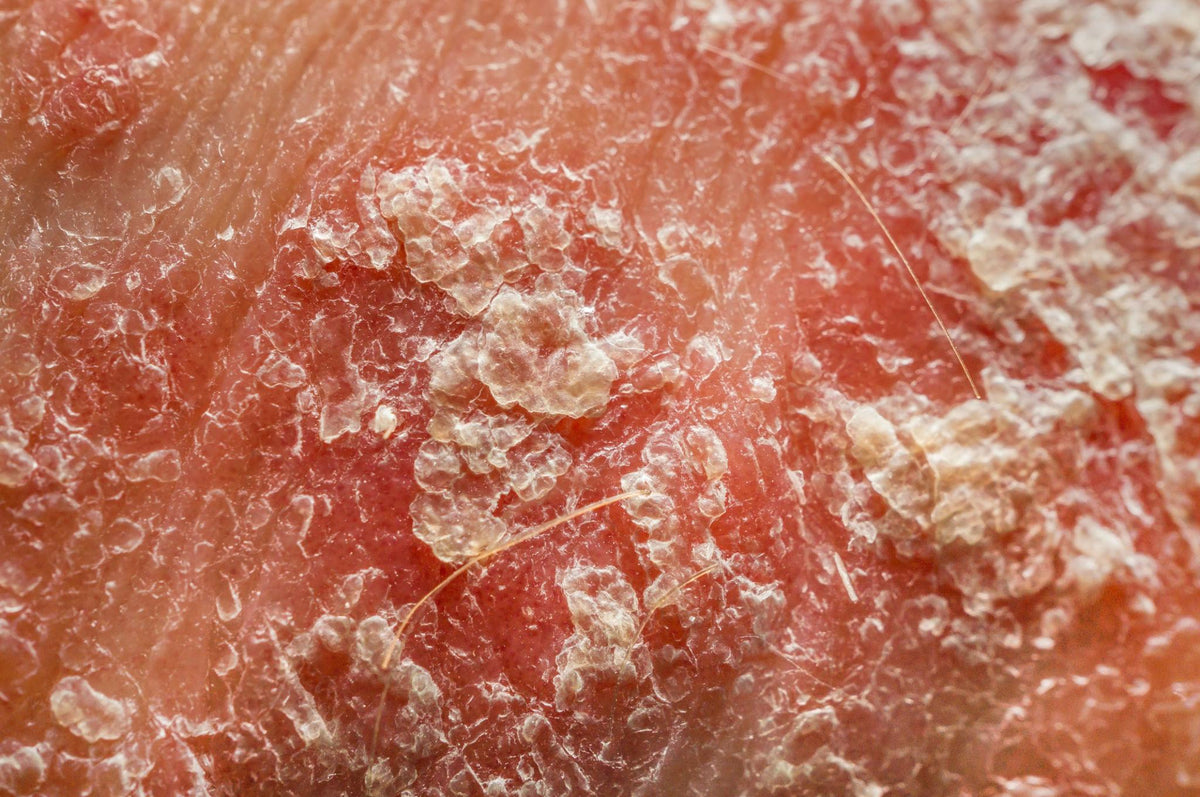 Psoriasis close up