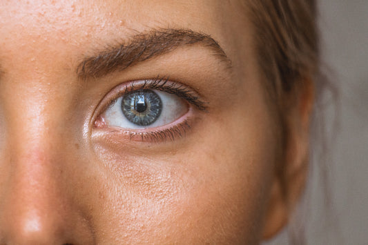 What are the causes of dark circles?