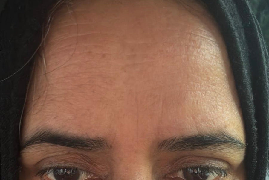 Customer skin before using Exosome Serum