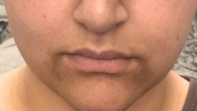Customer skin before using Exosome Serum and Bakuchiol Oil